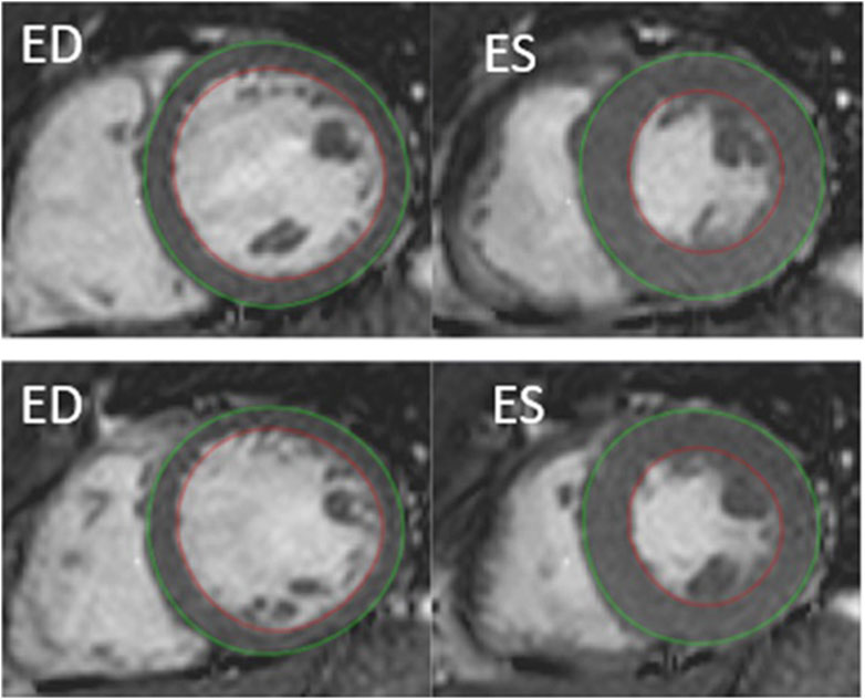 Hemoglobin concentration and blood shift during dry static apnea in elite breath hold divers